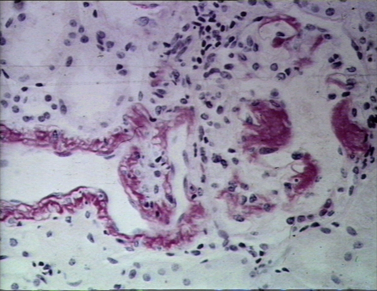 Amyloid in Glomerular caps Amyloid in Glomerular Capsule