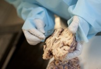 Ann McKee, Director of the Boston University CTE Center, works with a brain tissue sample showing signs of Chronic Traumatic Encephalopathy (CTE)