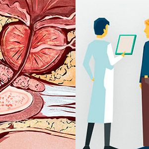 graphic showing the prostate gland and a prostate cancer care team