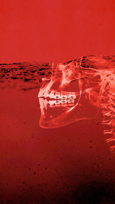 Photo illustration of an X-ray of a partial human face, focusing on the wired jaw.