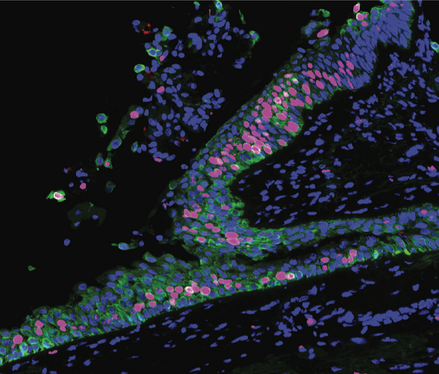 What If We Could Stop Lung Cancer Before It Starts?