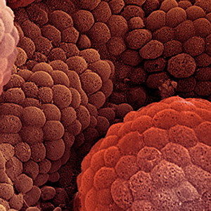 Prostate cancer cells