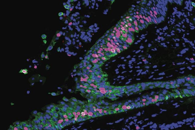 In this microscopic image of precancerous lung tissue, the hot pink cells are dividing faster than in normal lung tissue. Credit: Beane, et al., Nature Communications