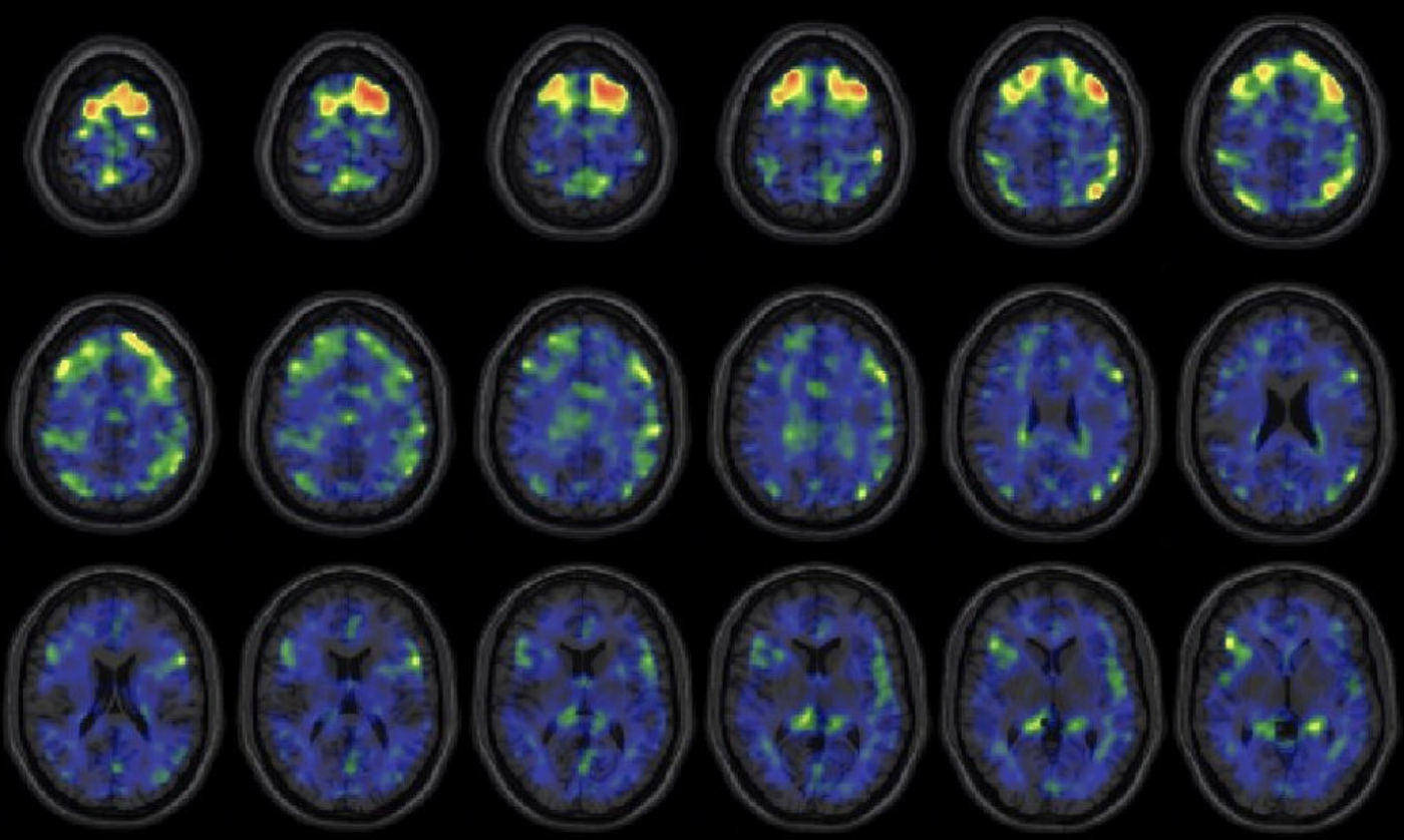 These images show areas of the brain where an experimental brain scan detected higher abnormal tau protein in a group of former NFL football players than compared to a group of a control subjects. The former football players in the study have self reported cognitive, mood and behavior symptoms that are thought to be associated with CTE. Courtesy of the New England Journal of Medicine