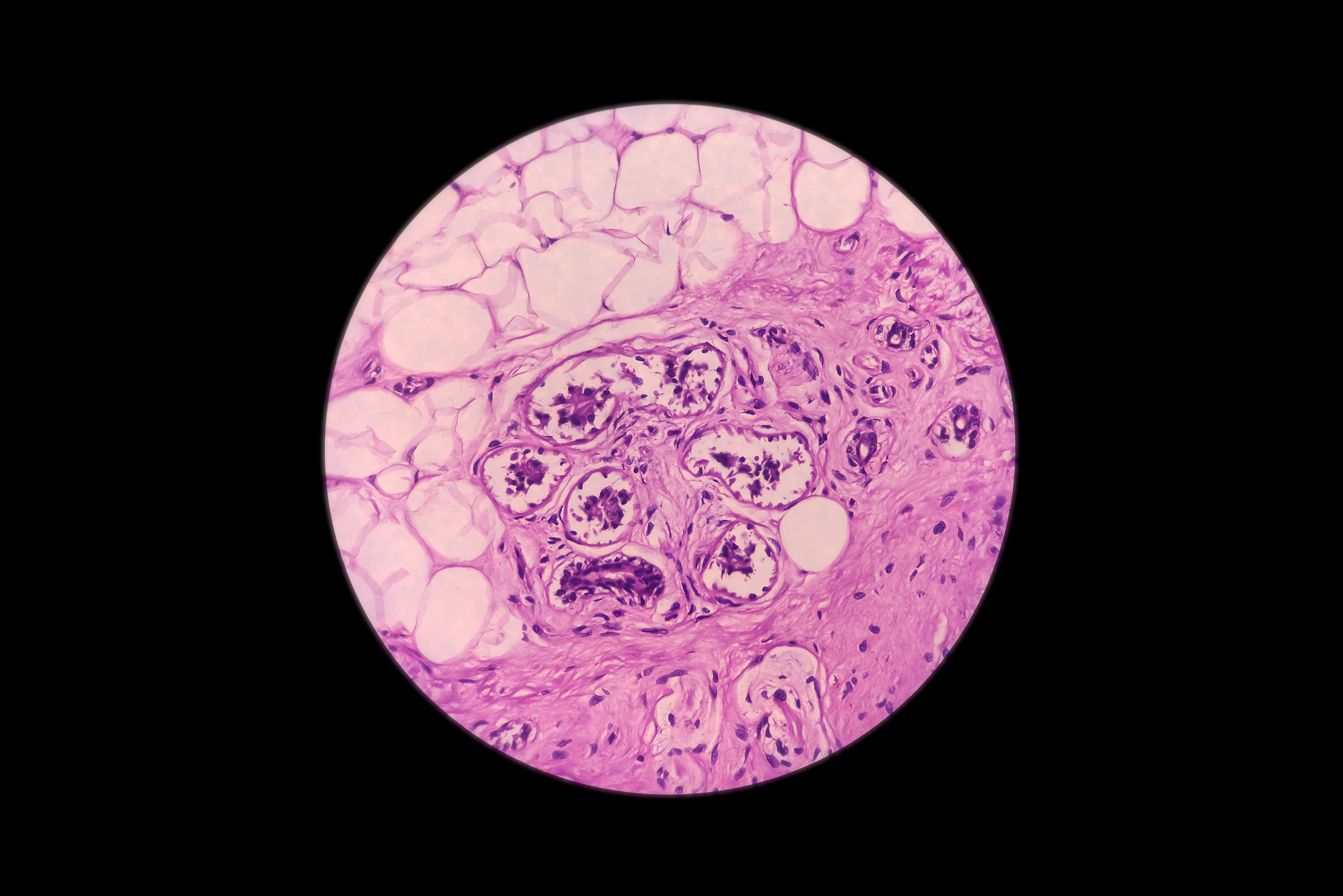Microscopic image of malignant melanoma in pink pigmented ulcer.
