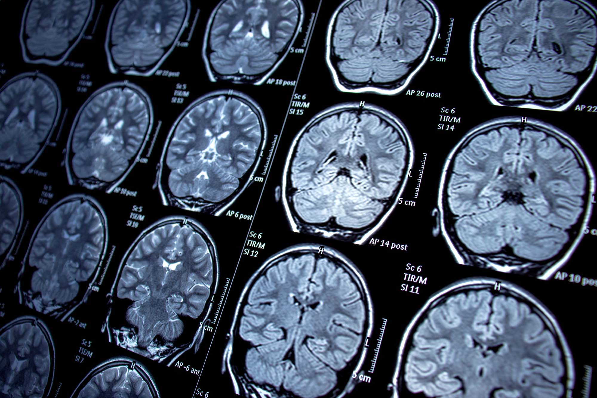 Photo of a series of black and grey brain scans.