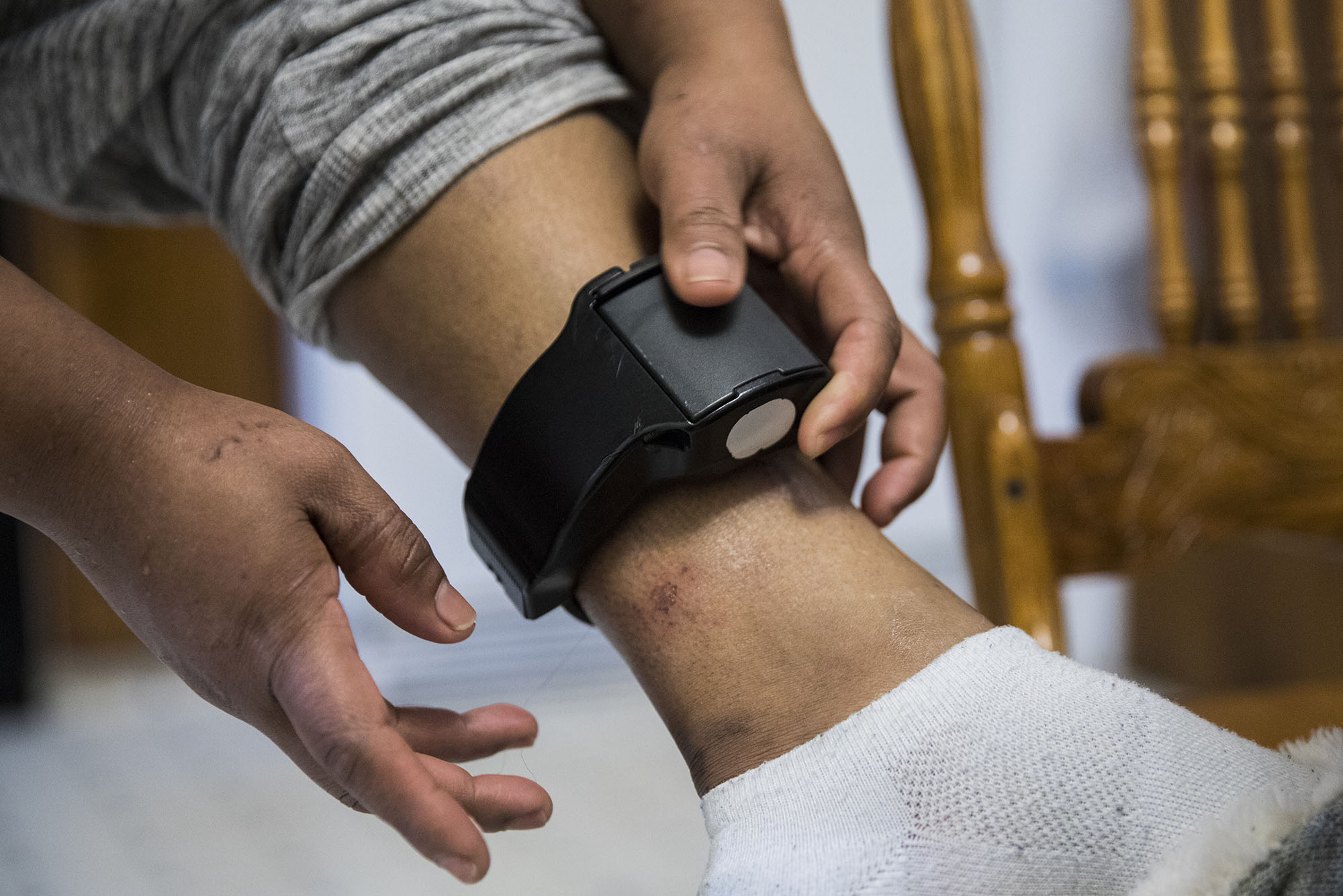Photo: Floricel Ramos shows the injuries caused by the ankle tracking device she must wear until her asylum court case is held. She holds the ankle monitor and shows the damage on her ankle.