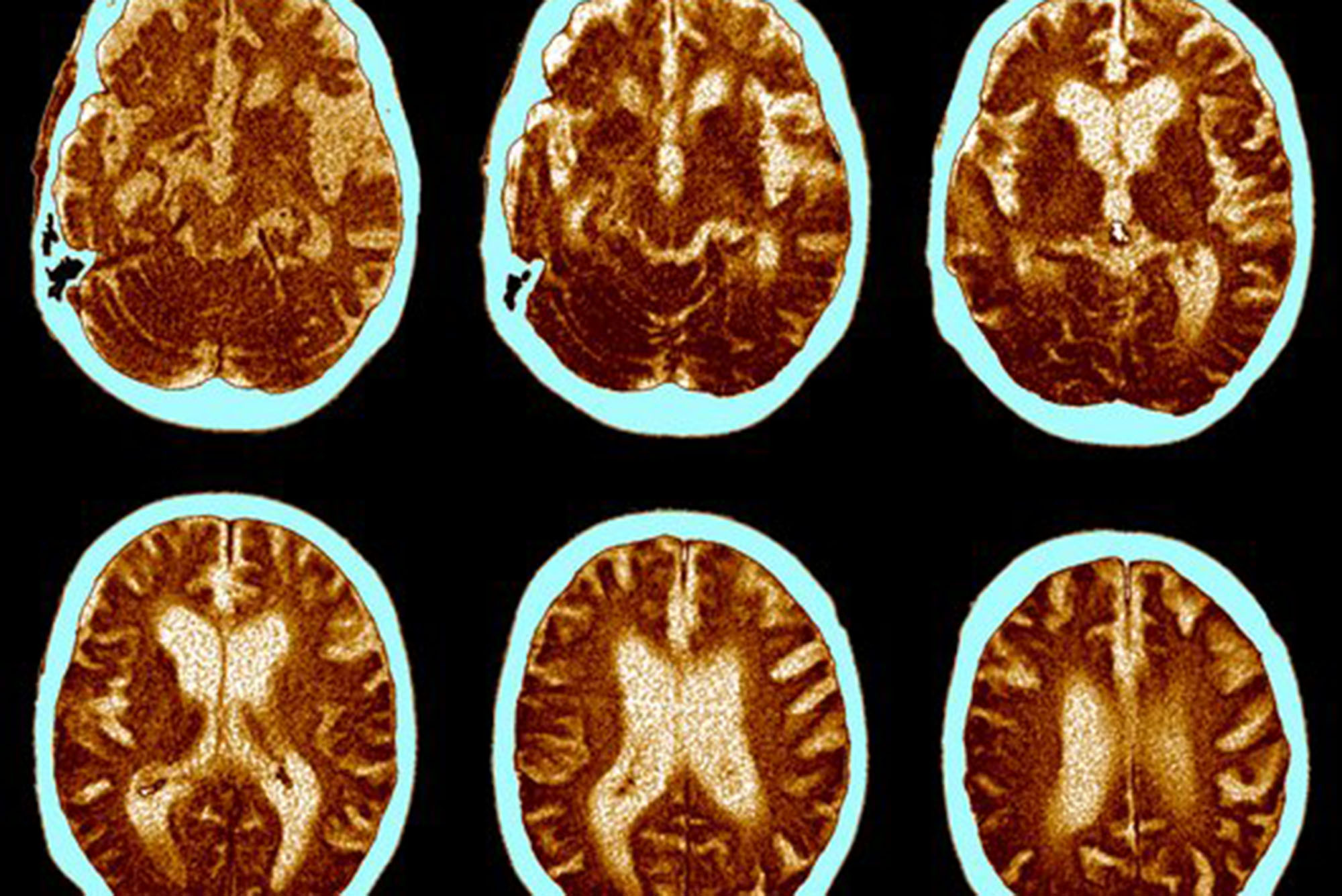 Photo: A CT scan of a brain with Alzheimer's disease