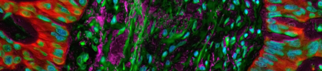 Lung cancer image