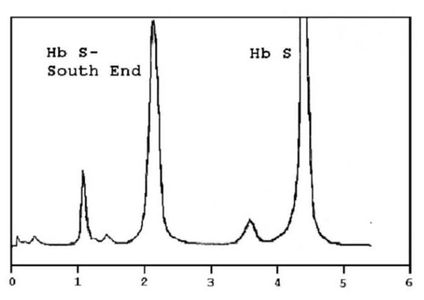 HPLC chromatogram of Hb S-South End and Hb S