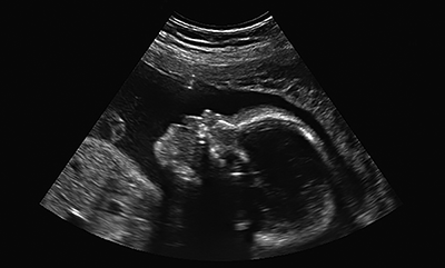 thumbnail-ultrasound