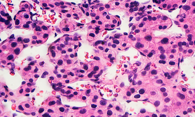 Liver Cancer (Hepatocellular Carcinoma) under a microscope