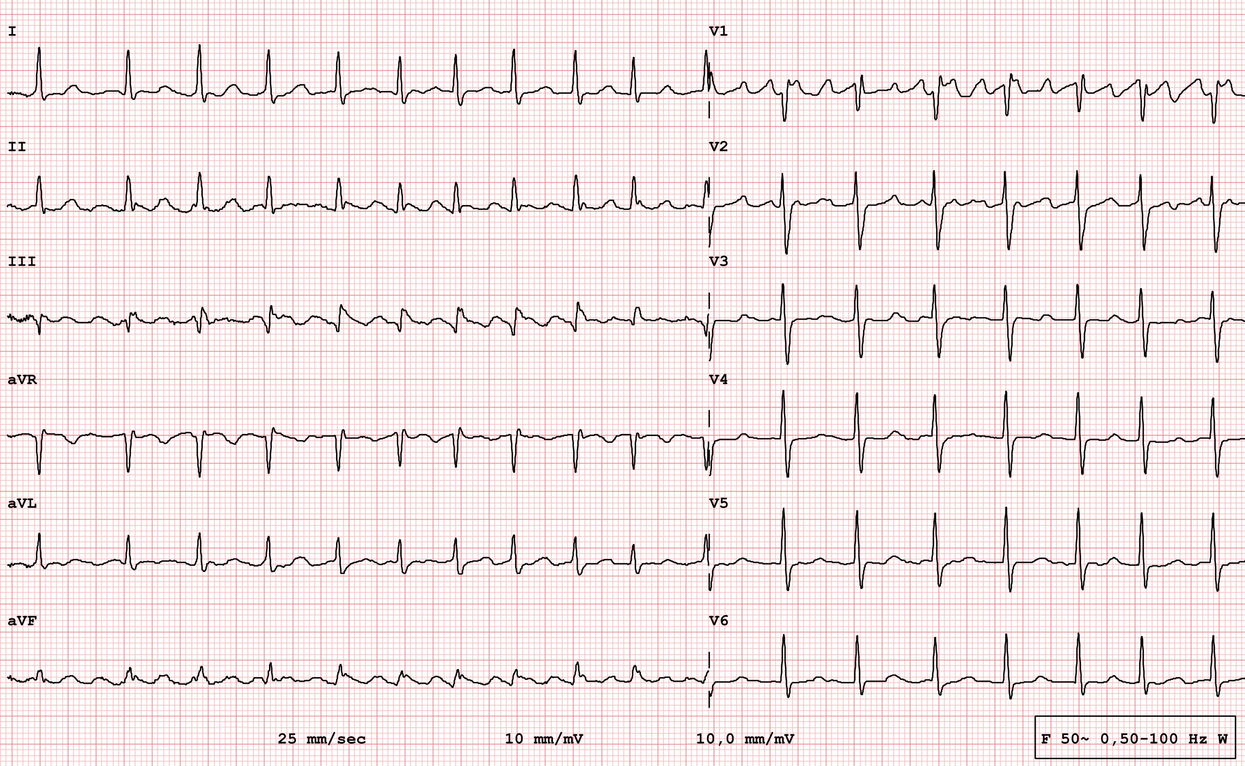 ECG example of a pathological 12-lead rhythm, atrial flutter