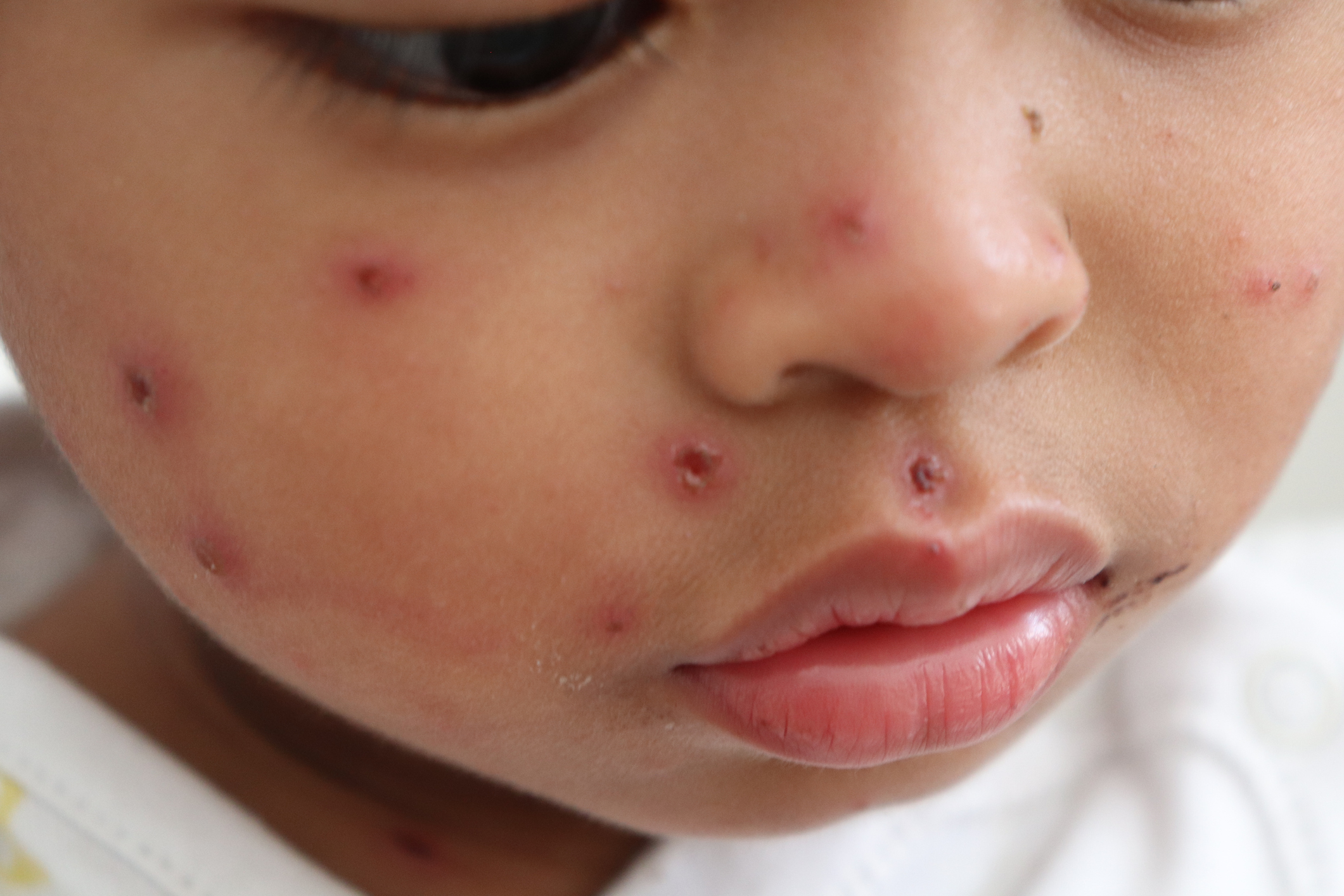 Closeup of a child's face with measles wounds
