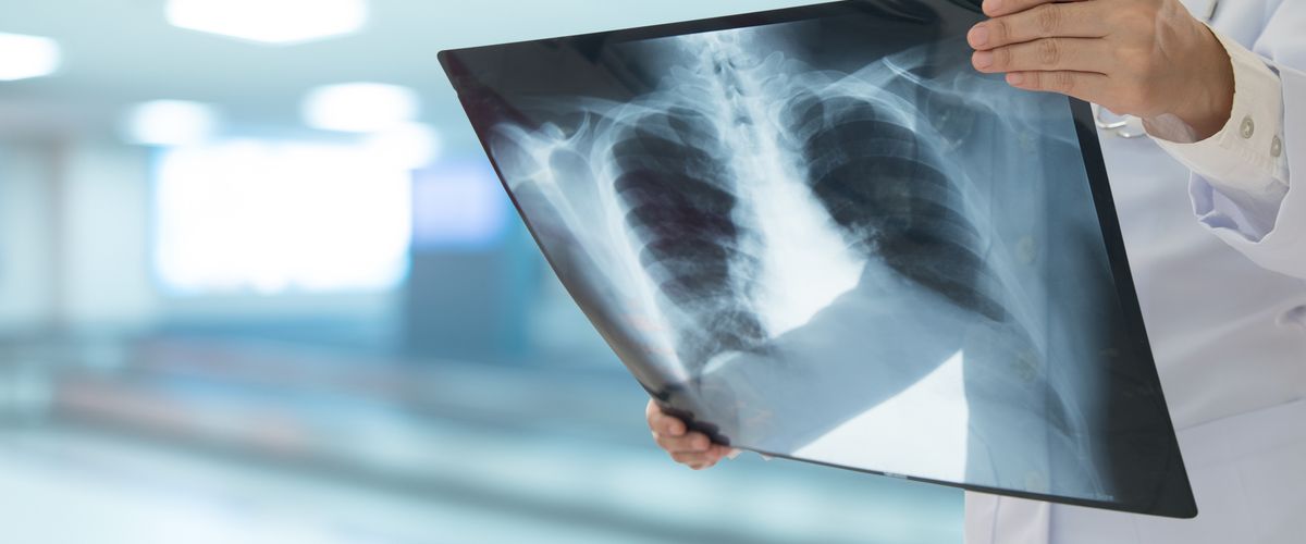Doctor radiology looking chest or lung x-ray image to diagnose pneumonia or inflamed lungs. medical checkup concept.